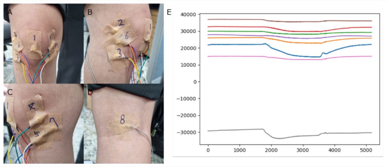 Knee electrode placement and cartilage bioelectric signals