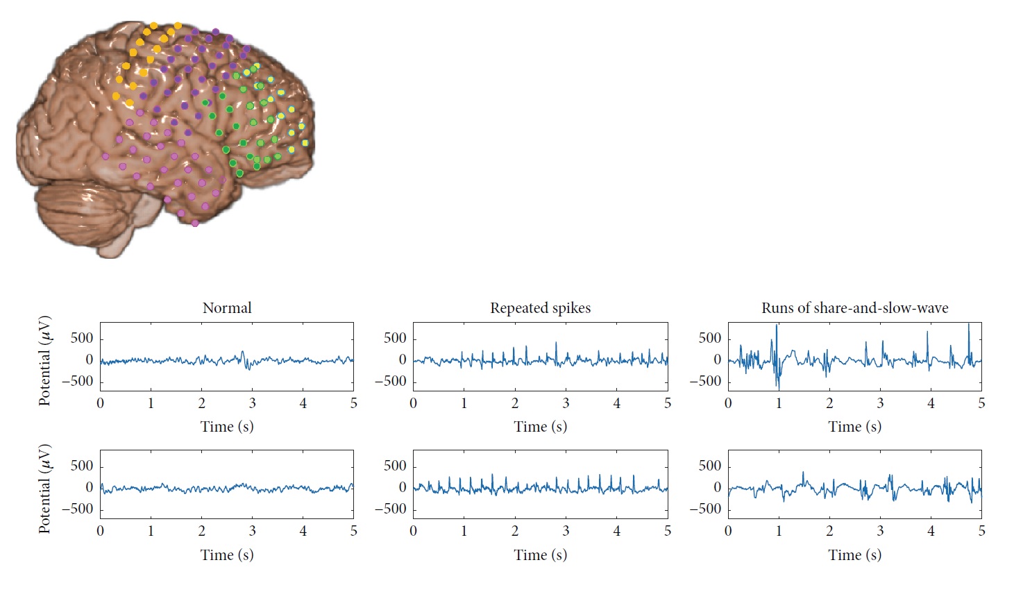 EEG signal processing